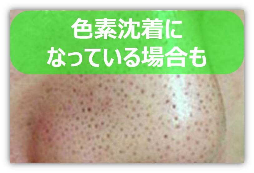 鼻の黒ずみ 色素沈着.jpg